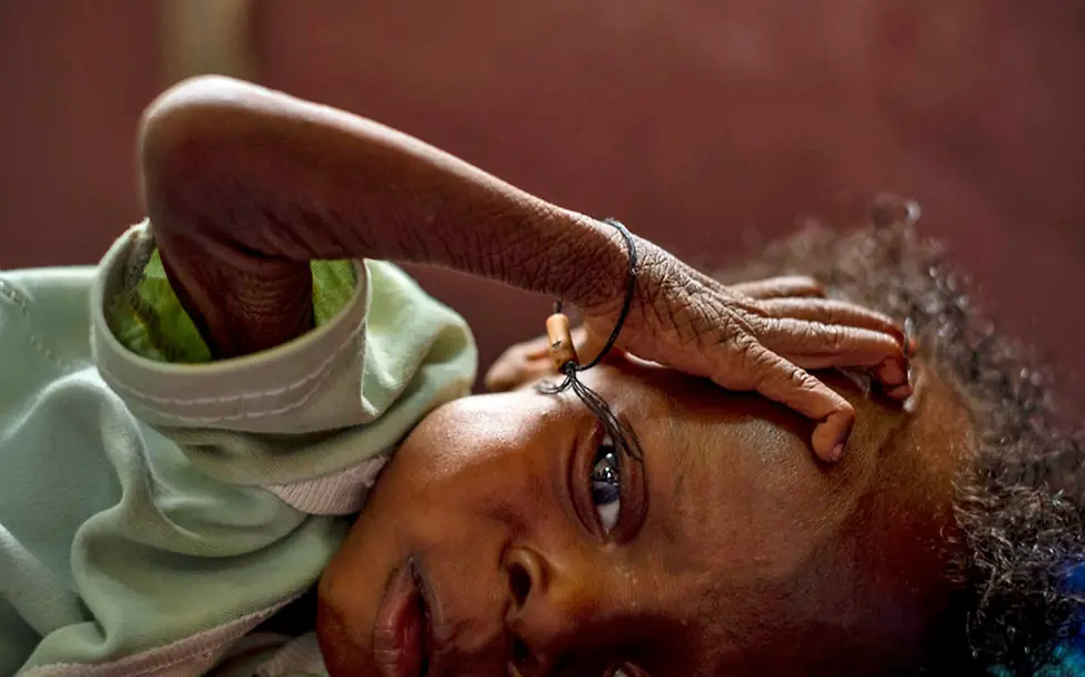 Kampf gegen den Hunger: Esther braucht Hilfe, um zu überleben. | © UNICEF/Gilbertson VII Photo Esther ist akut mangelernährt und liegt im Krankenhaus.