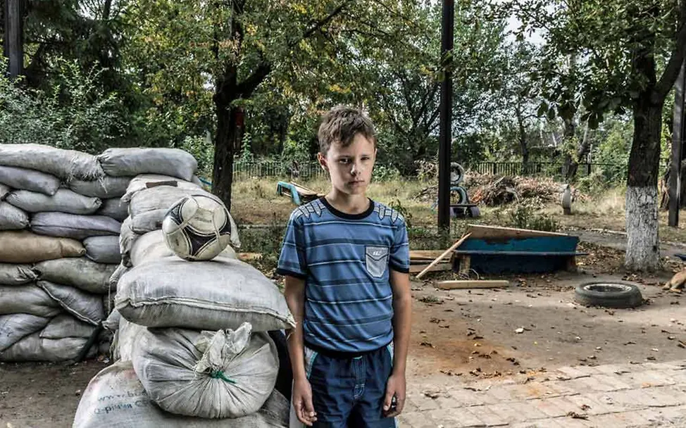 Artyom wurde bei einem Angriff schwer verletzt. | © UNICEF/Morris VII Photo Artyom hat ein Stück Schrapnell in seinem Rücken.