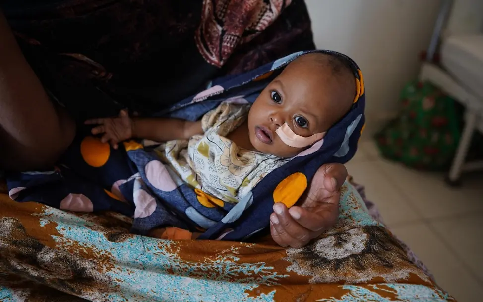 Foto-Reportage: Dürre am Horn von Afrika | © UNICEF/Sewunet Somalia: Baby bekommt über eine Sonde Nahrung.