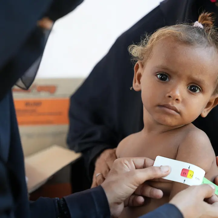 Hunger im Jemen: Ein Kleinkind wird mittels Oberarmmessung auf Mangelernährung untersucht. 